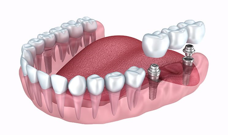 render of how dental implants are placed in