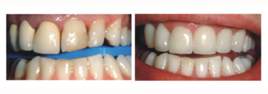 smile transition through the procedure